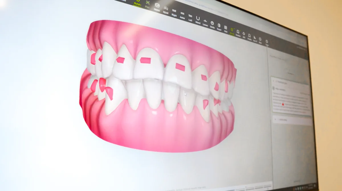 Invisalign Clear Aligners