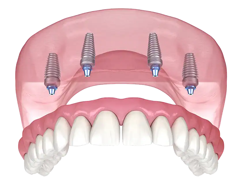 All-on-4 Dental Implants