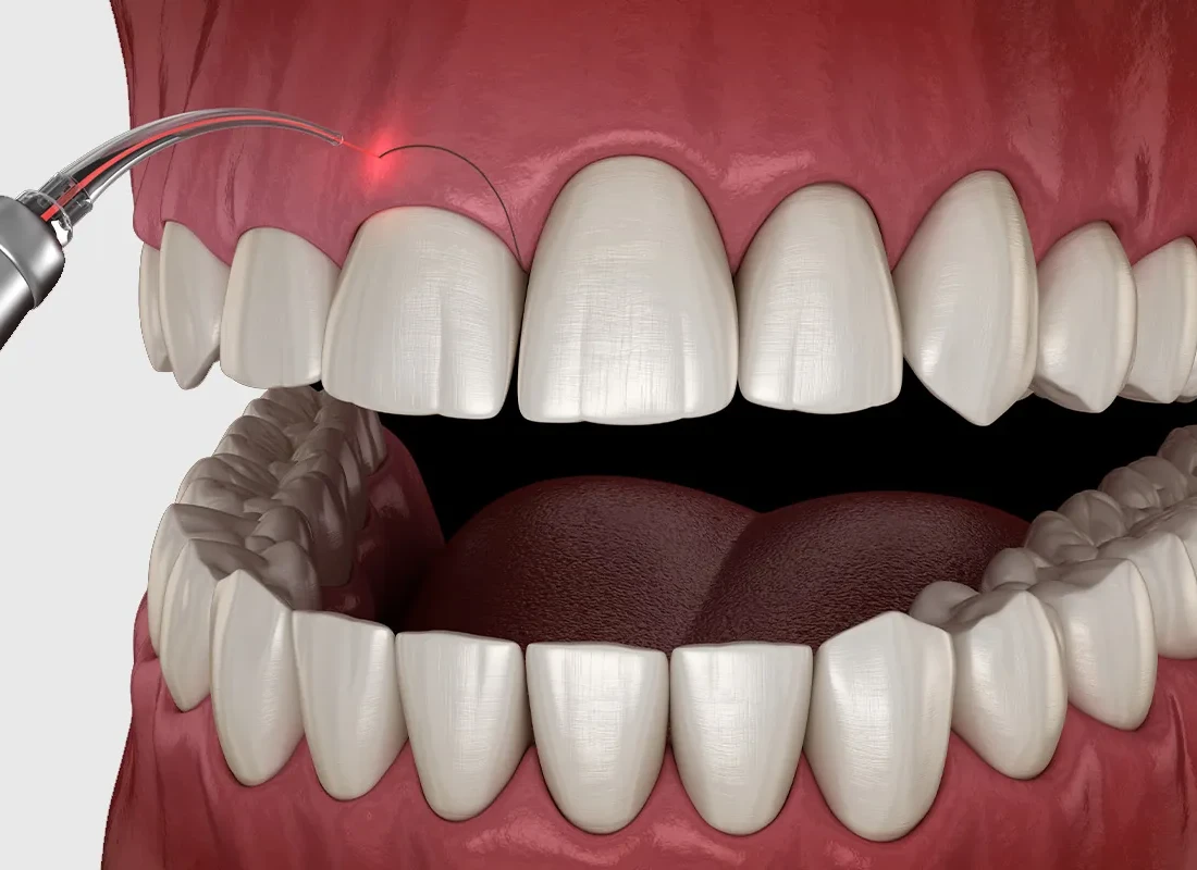 What is Gum Contouring