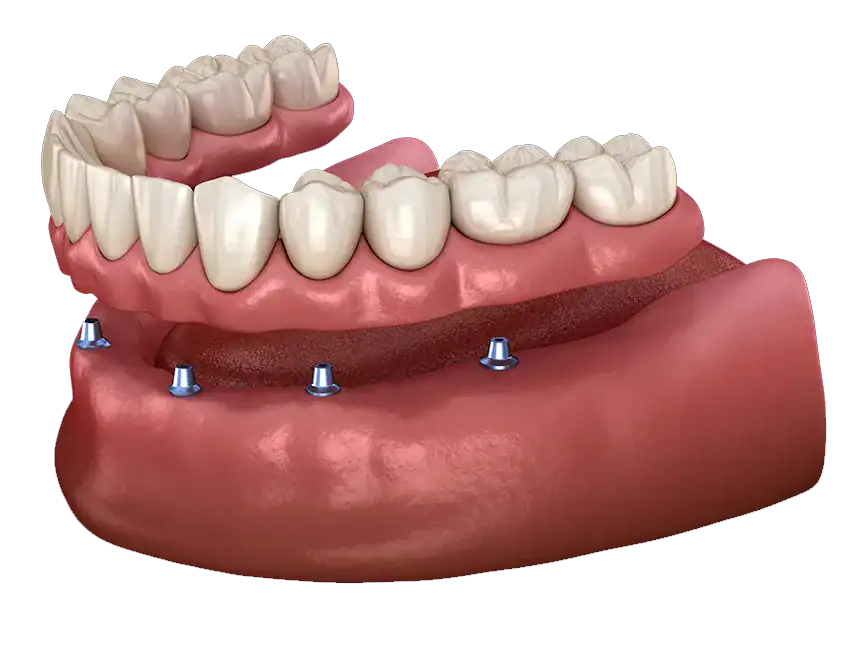 What is Implant-Supported Dentures