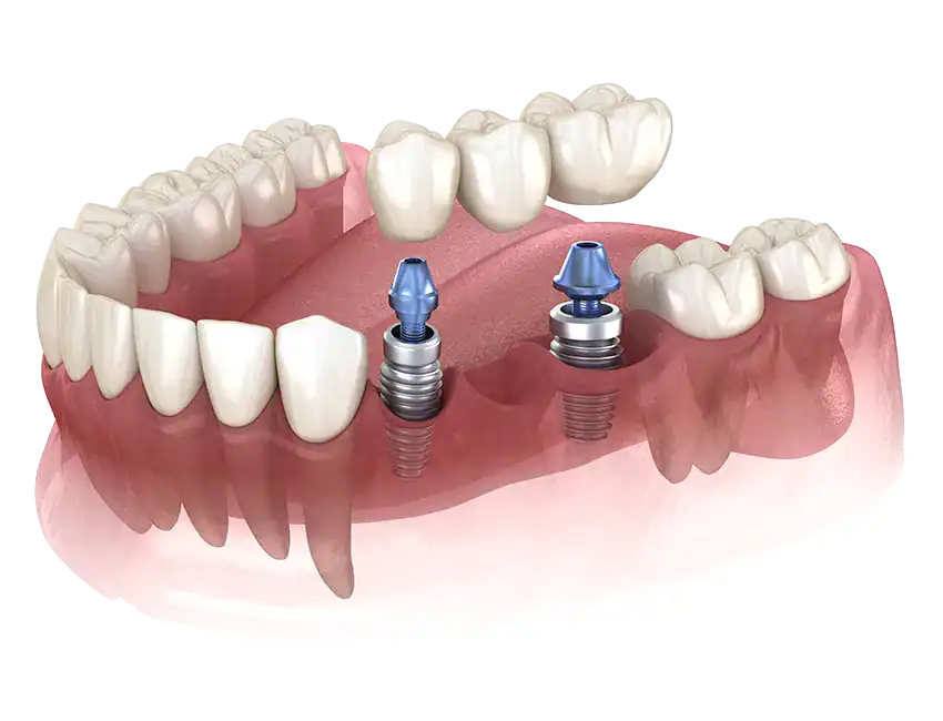 Multiple-Tooth Implant Bridges