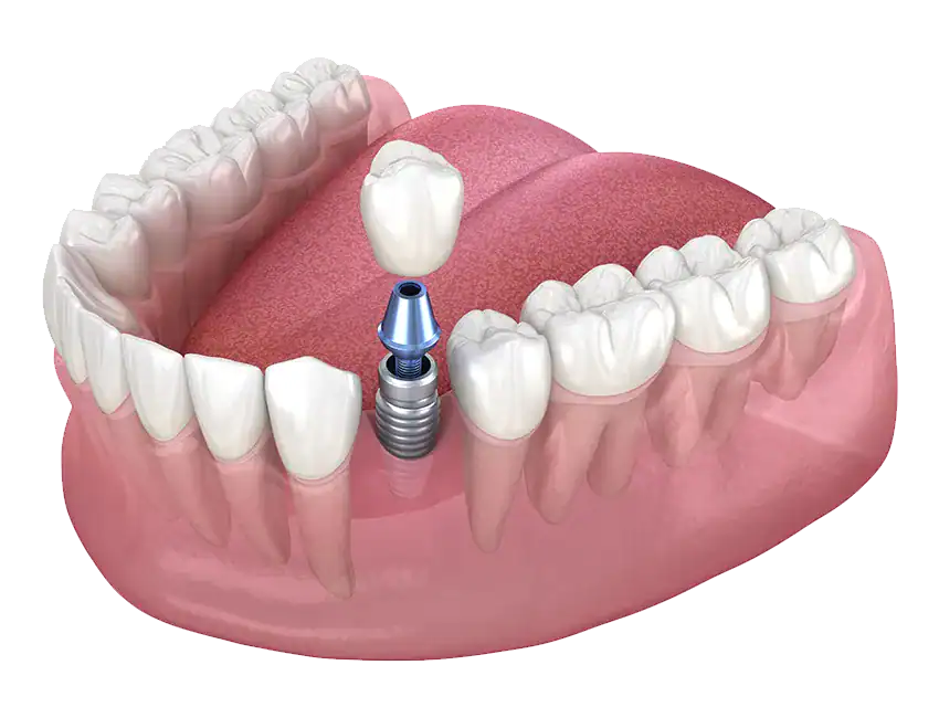Single-Tooth Replacement