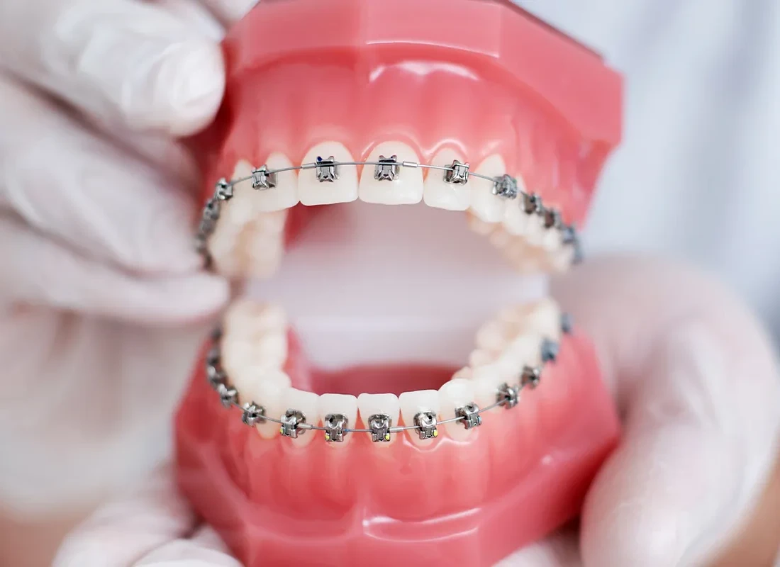 Braces in Encinitas, CA
