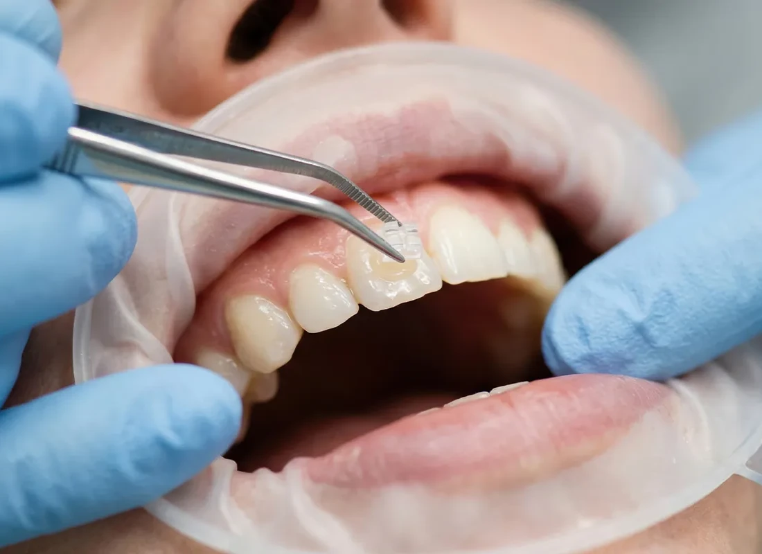 Dental Bonding in Encinitas, CA