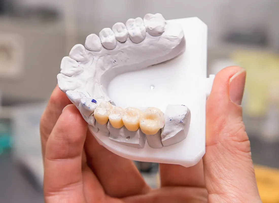 What is Dental Bridges
