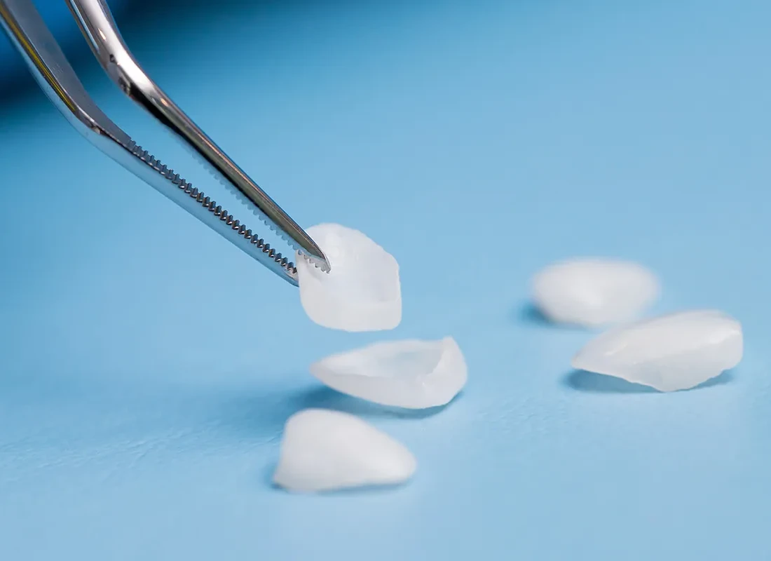 What is Dental Veneers