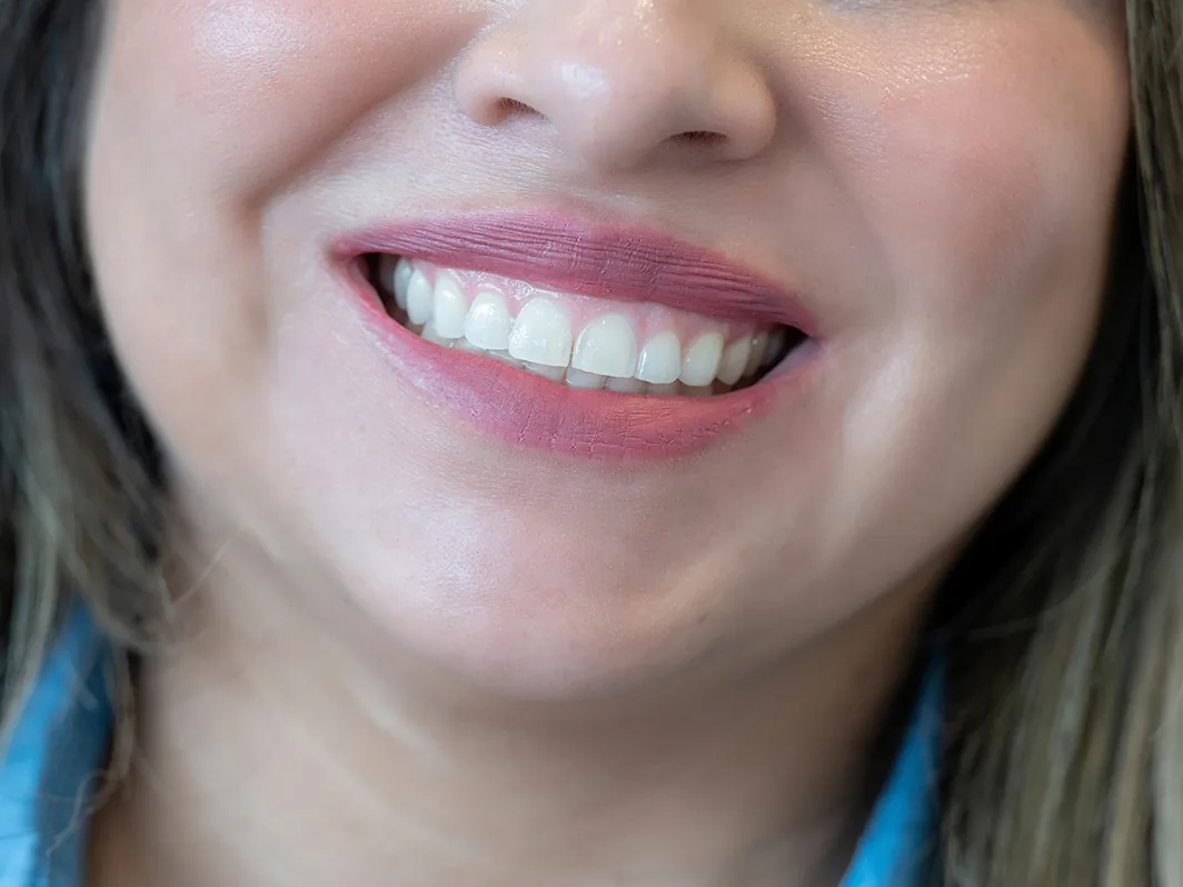 What is Smile Makeover
