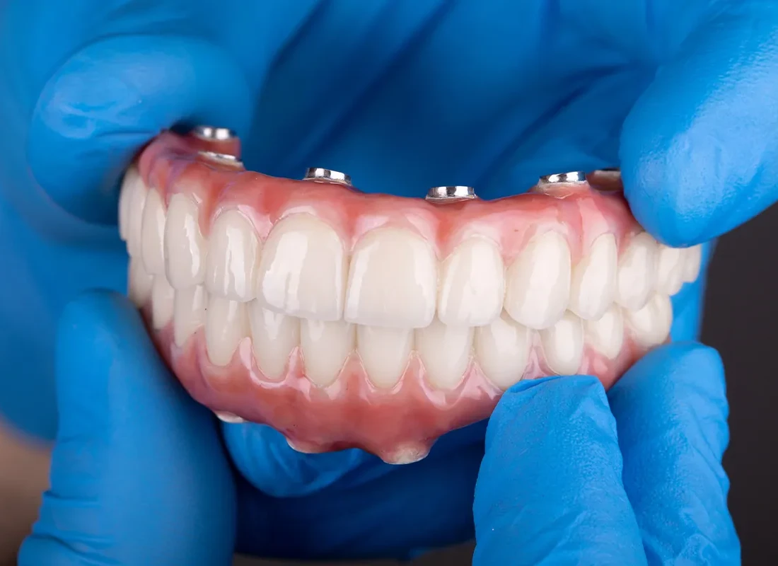 Are Dental Implants Worth It After 50? What Patients Should Know