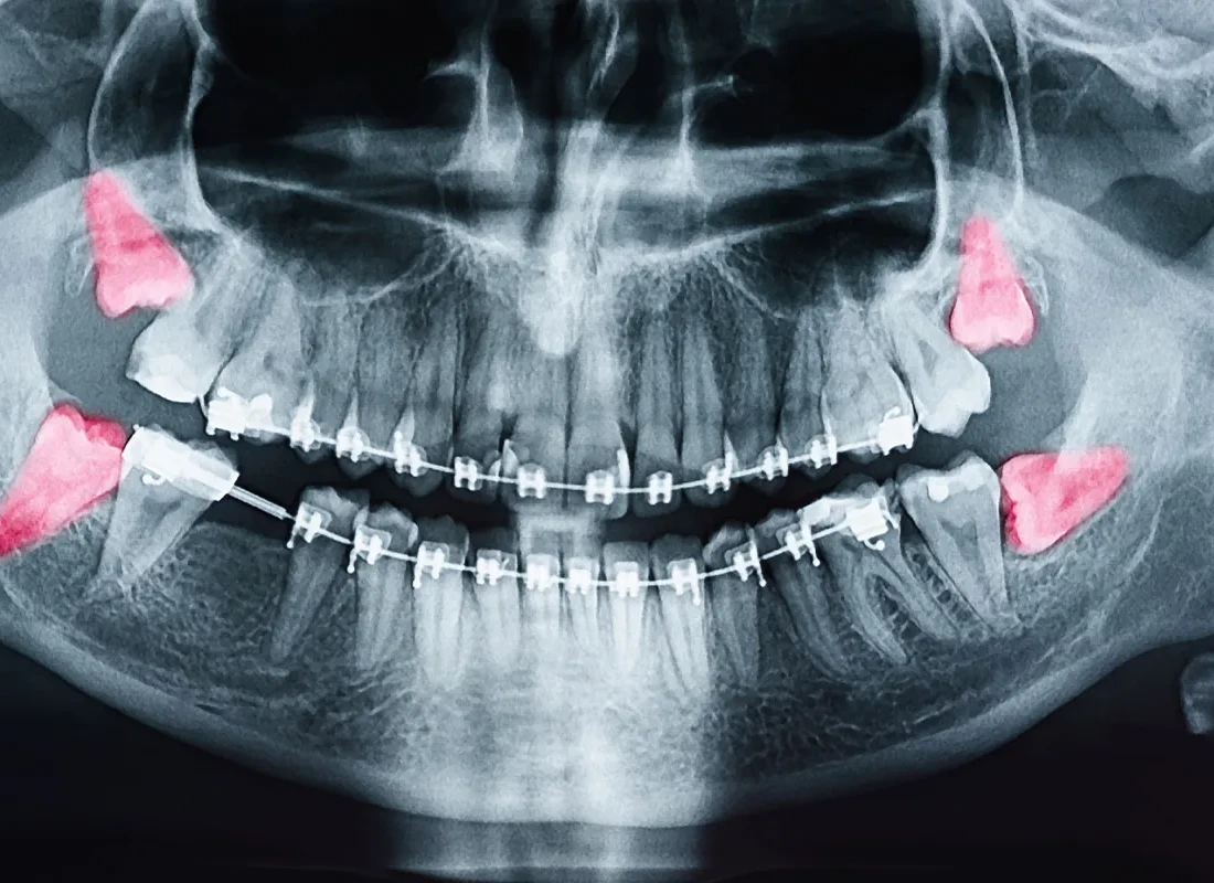 Wisdom Teeth Removal in Encinitas, CA